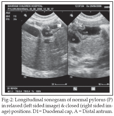 The validity of Ultrasound in Diagnosing Hypertrophic Pyloric Stenosis