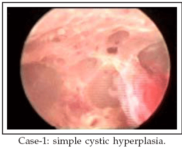 endometrial cancer on hysteroscopy