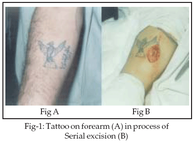 Surgical management of tattoos
